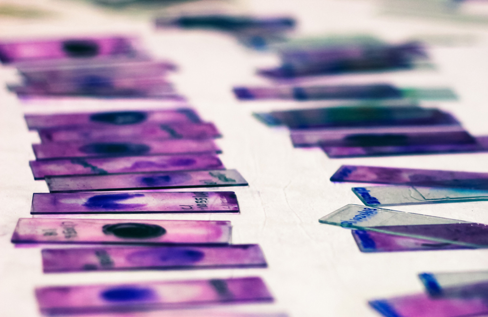 stained glass slides of peripheral blood smear with violet leishman giemsa stain in hematology pathology laboratory